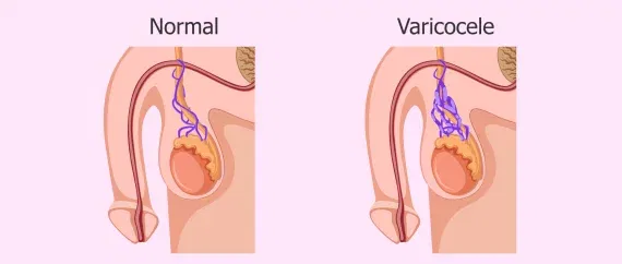 varicocele