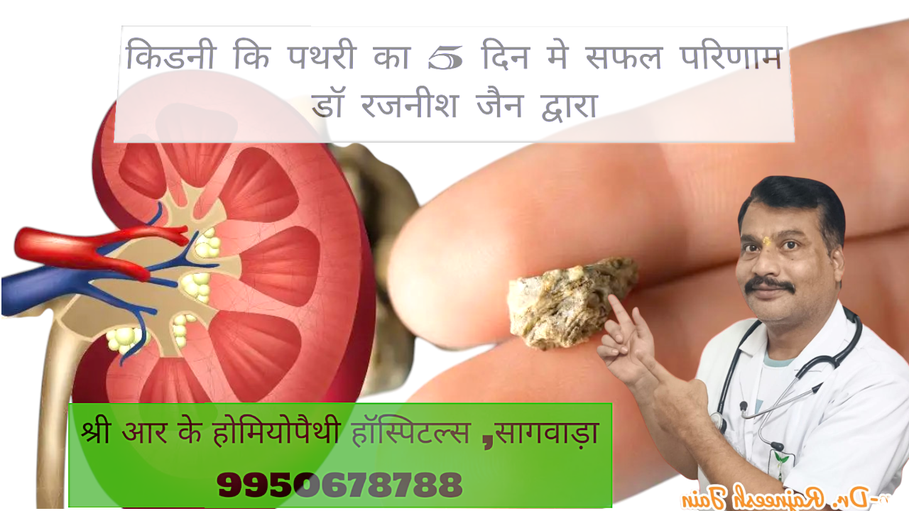 KIDNEY STONE