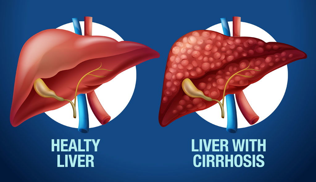 Liver Cirrhosis