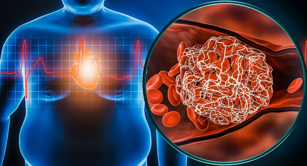 Ischaemic Heart Disease