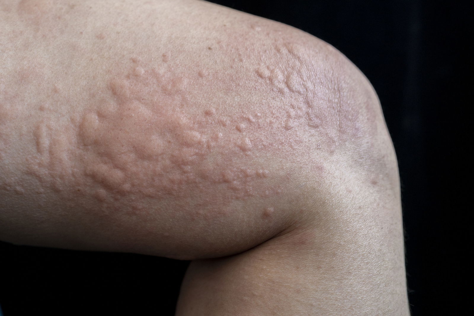 Urticaria Hives