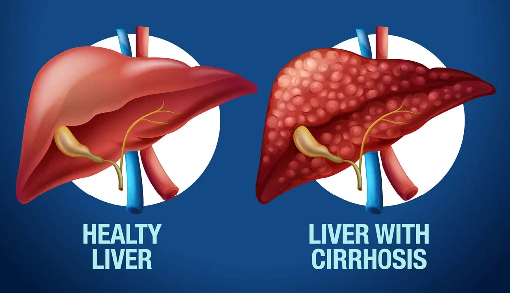 liver cirrosis image