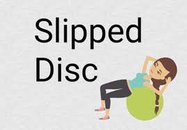 slip disc